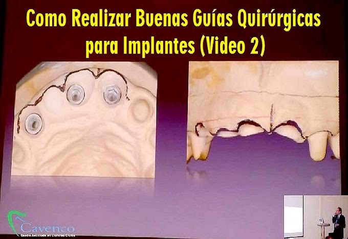 VIDEOCONFERENCIA: Como Realizar Buenas Guías Quirúrgicas para Implantes (Video 2)