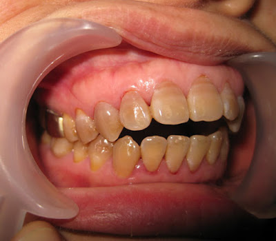  Nguyên nhân răng sứ bị vàng ố