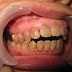  Nguyên nhân răng sứ bị vàng ố