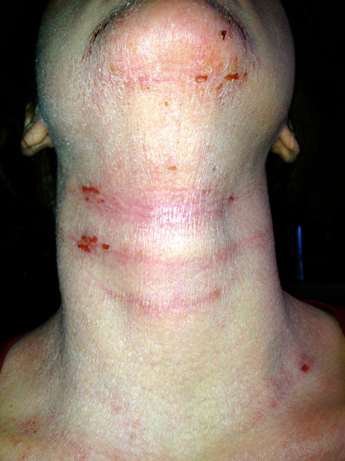 Scratching The Surface Of Topical Steroid Withdrawal February 2015