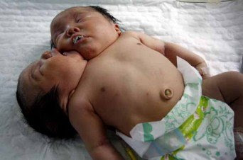 two headed baby in china 2011