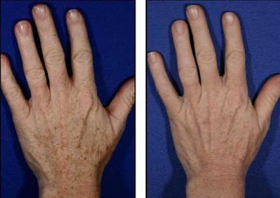 6 amazing hand rejuvenation photos