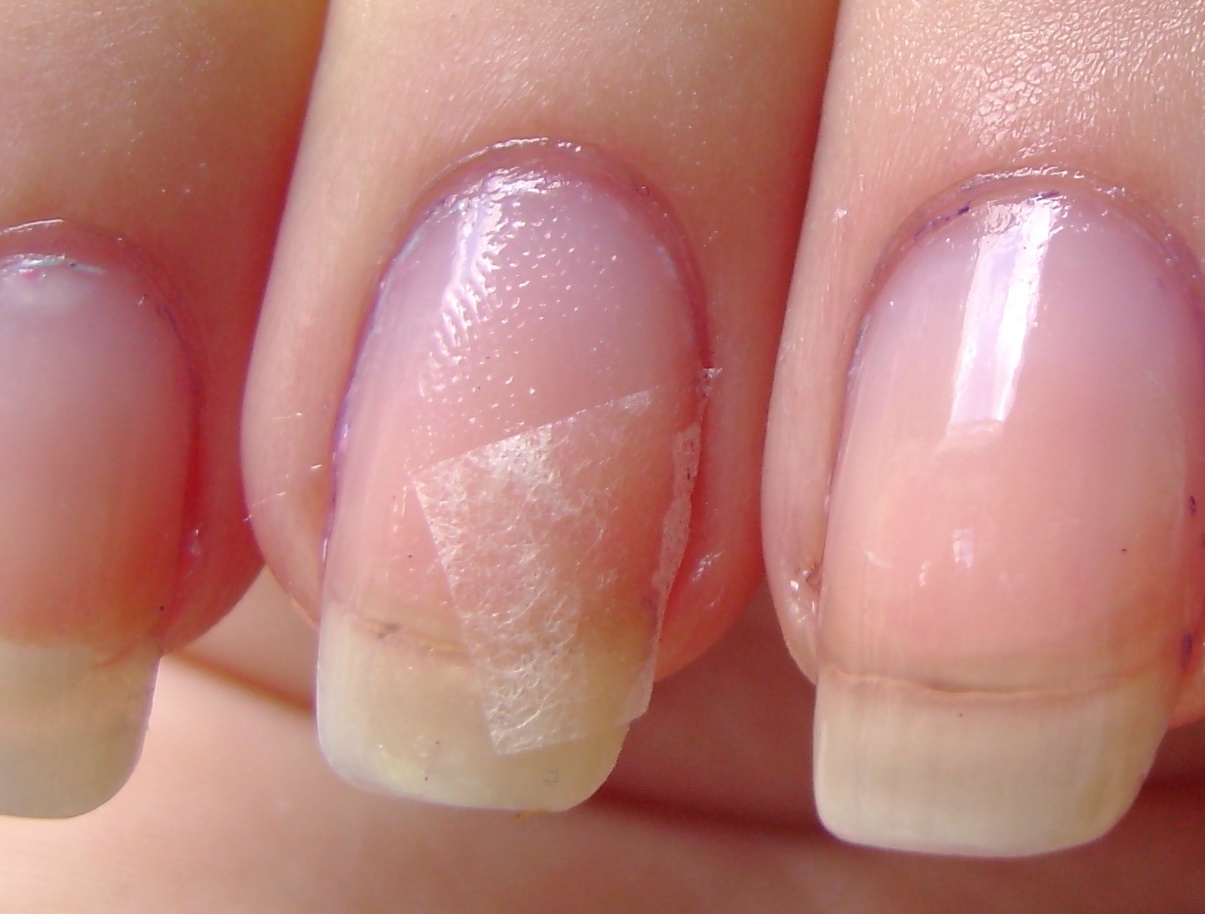 Brittle Splitting Nails - American Osteopathic College of ...