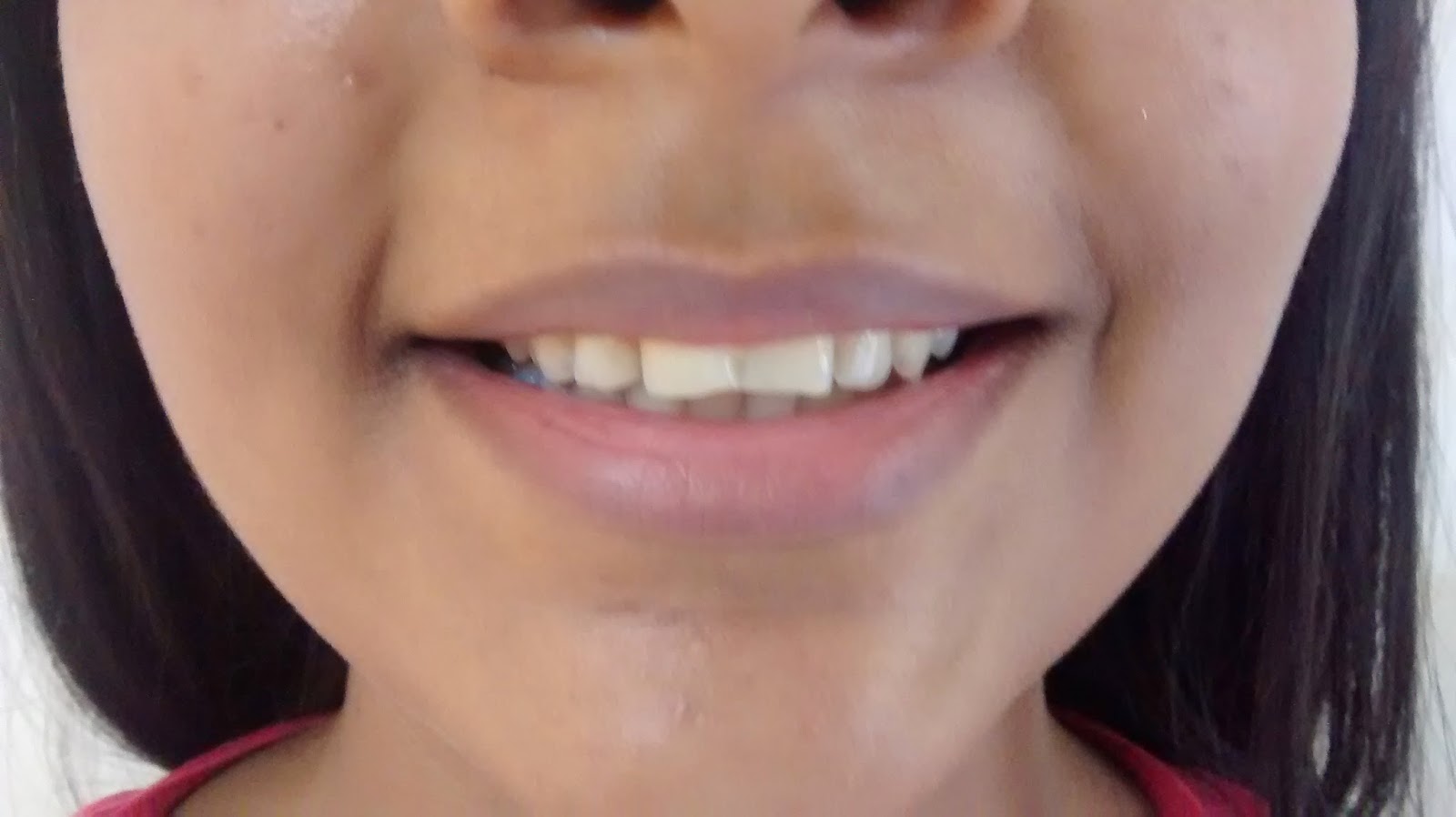 Diseño de Sonrisa