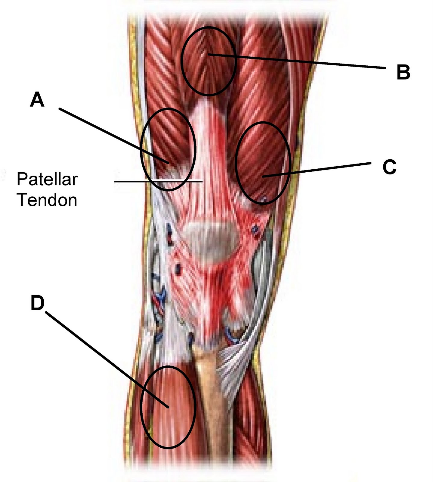 Тендинит коленных связок. Сухожилие полуперепончатой мышцы. Тендинит сухожилия подколенной мышцы. Тендинопатия сухожилия коленного сустава. Тендиноз сухожилия коленного сустава.