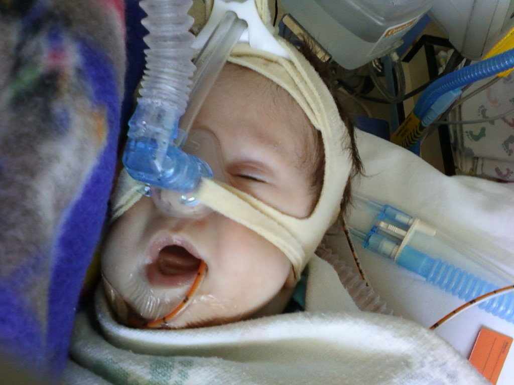 Shooting For Liam: Feeding Tubes: Whats the difference?