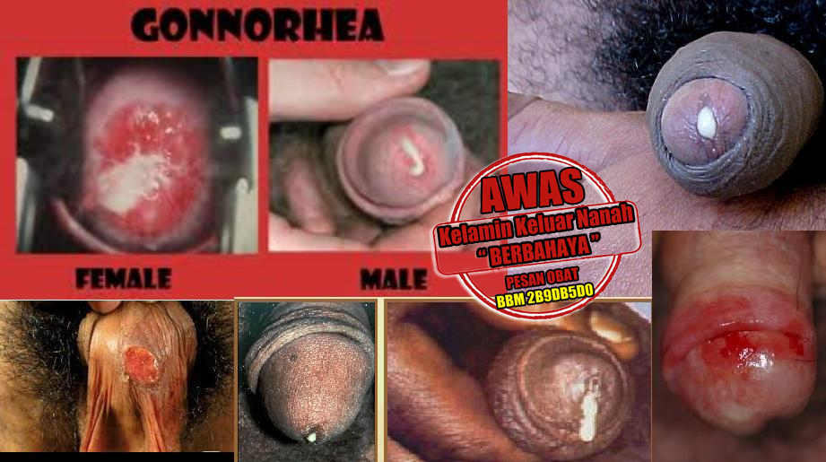 Alternatif Pengobatan Kencing Nanah Selain Secara Medis Alternatif Pengobatan Kencing Nanah Selain Secara Medis
