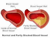 The-effect-of-fats-on-blood-vessels_1 difference between healthy and clogged blood vessels