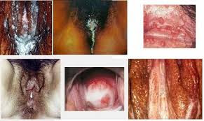 Mengapa perempuan saat kencing terasa perih dan bercampur dengan darah dan nanah