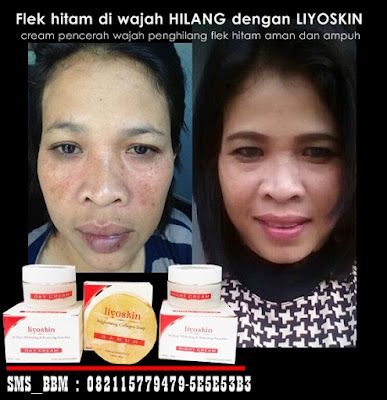 Cream Wajah Untuk Mengatasi Hiperpigmentasi Liyoskin Cream Wajah Untuk Mengatasi Hiperpigmentasi