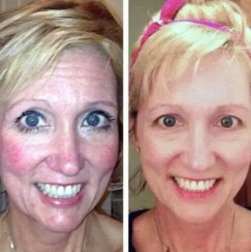 Flexing Your Face With Facial Gymnastics To Gain A NonSurgical Facelift