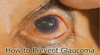 How to Prevent Glaucoma