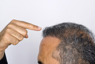ما هي أسباب تساقط الشعر أسباب تساقط الشعر عند الرجال