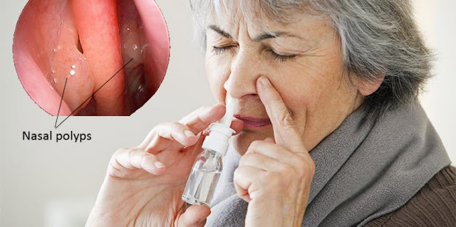 Cara Menghilangkan Polip Hidung Cara Menghilangkan Polip Hidung