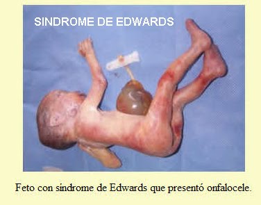 TRISOMIA 18 SINDROME DE EDWARDS DOWNLOAD TRISOMIA 18 SINDROME DE EDWARDS DOWNLOAD