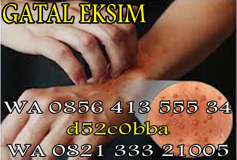 Foto Salep Ampuh Untuk Penyakit Eksim Gatal Di Tangan