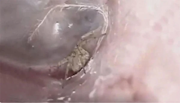  News, China, Hospital, Doctor, World, Spider, China: Surgeons find spider spinning web inside a man's ear