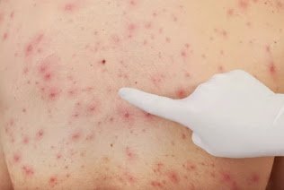 Penyakit Rubella Pengobatan Rubella Secara Alami