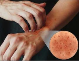 El tratamiento láser de la psoriasis de la cabeza
