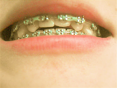 braces teeth