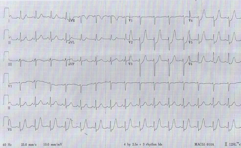 EM CaseLink Jiu Jitsu 1, Myocardium 0. Chest Pain After Jiu Jitsu