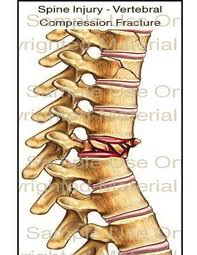 Home: CEDERA PADA TULANG PUNGGUNG ATAU TULANG BELAKANG