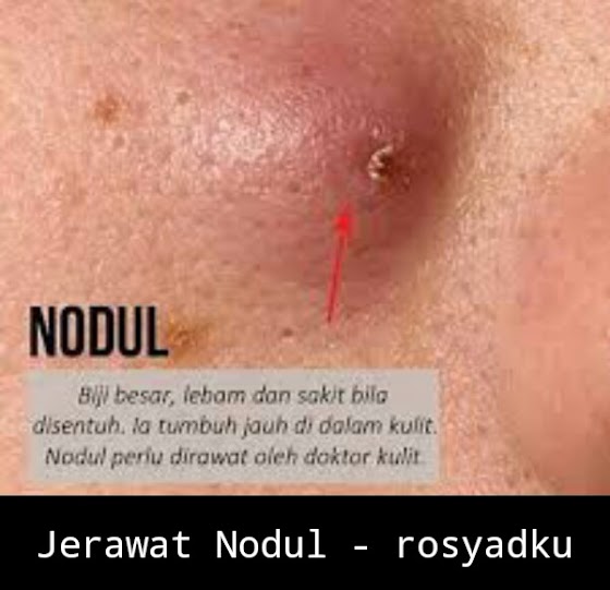 Freederm Gel Obat Jerawat