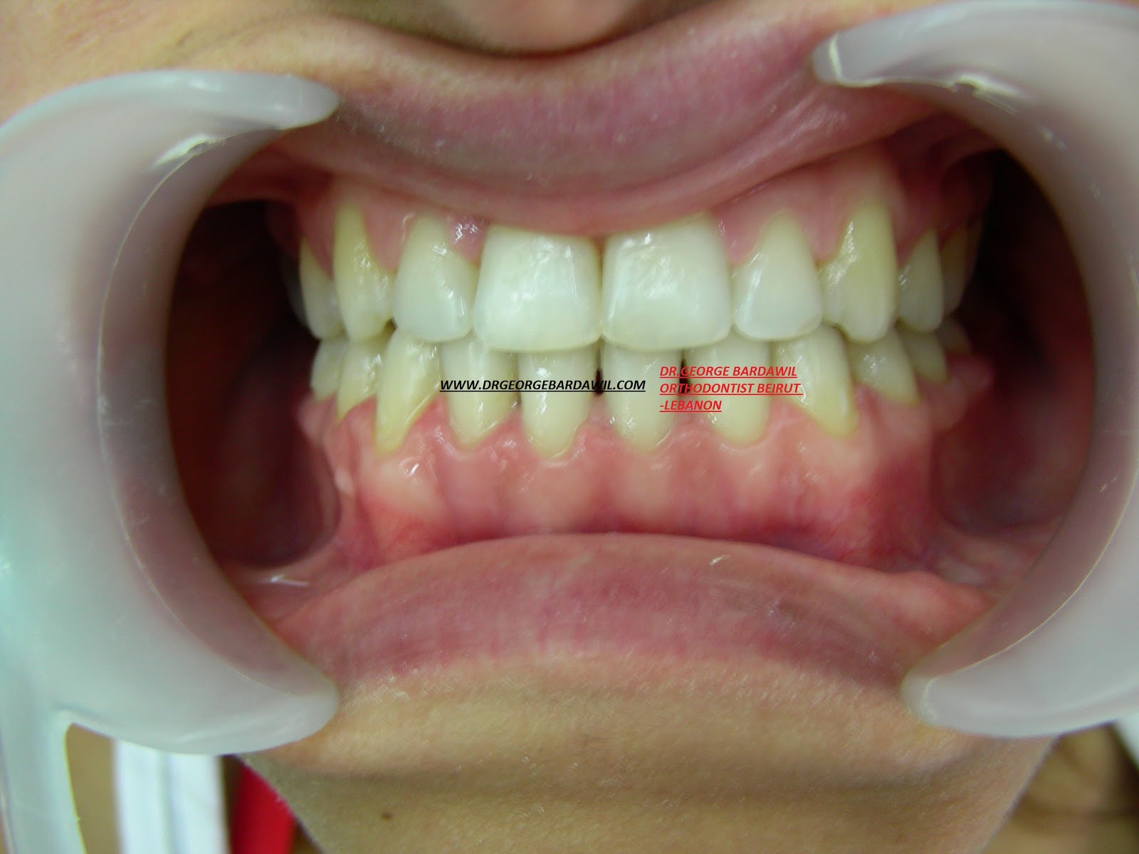 E. BardawilOrthodontistInvisalign Diamond level underbite