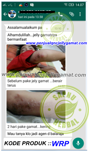 Obat Bintik Berair Pada Kulit Terampuh Obat Bintik Berair Pada Kulit Terampuh