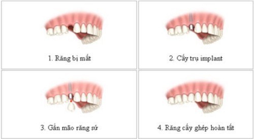 PHỤC HÌNH RĂNG SỨ TRÊN IMPLANT QUÁ SỚM VÀ NHỮNG TÁC HẠI -16