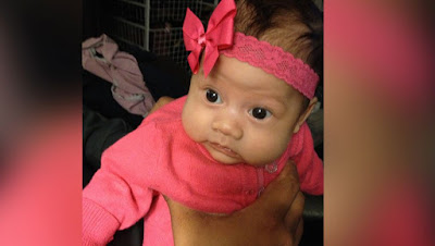 Bayi Ajaib Yang Lahir Dengan Kondisi Langka di Dunia Bayi Ajaib Yang Lahir Dengan Kondisi Langka di Dunia