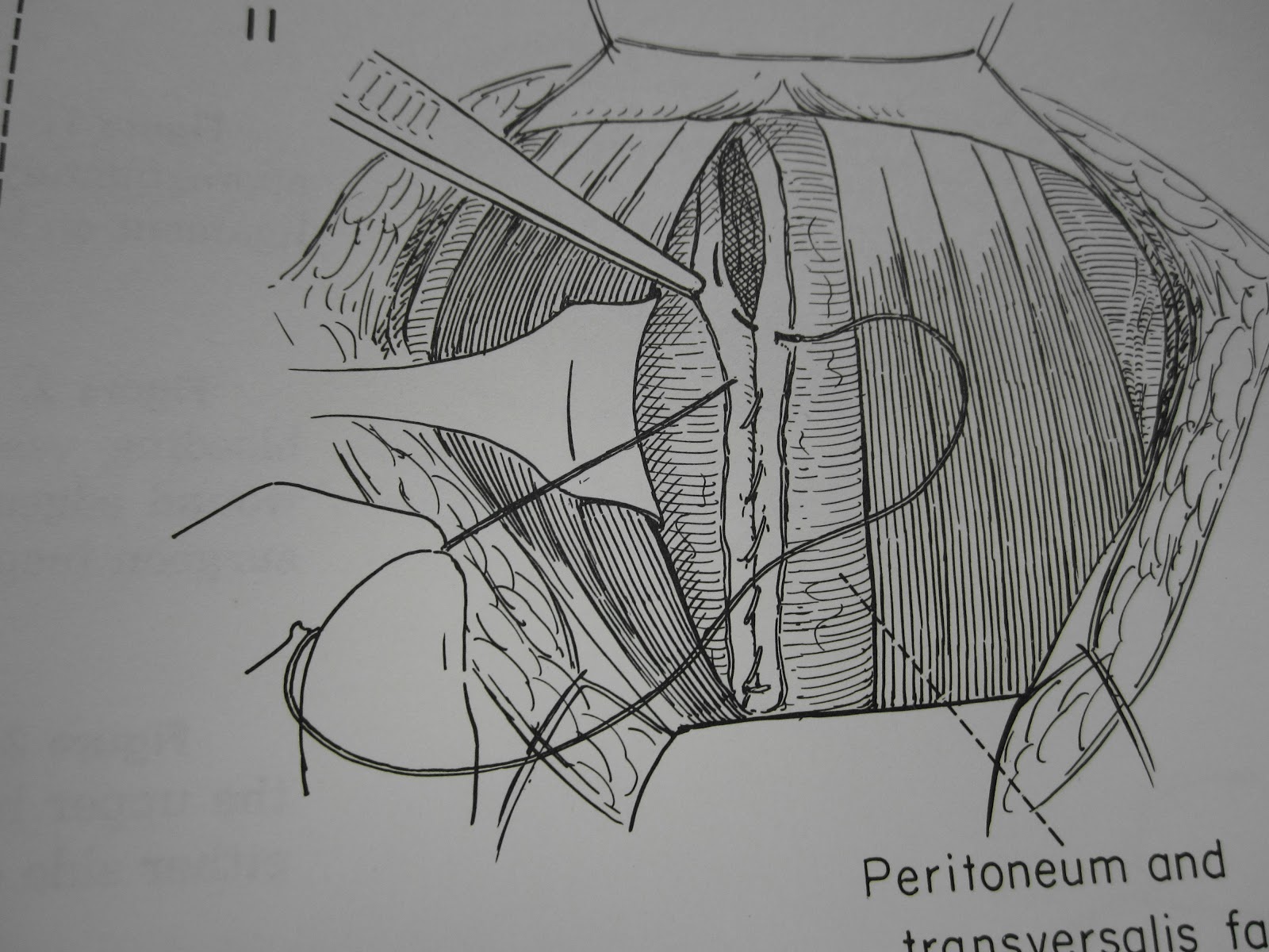 The Pfannenstiel Incision Opening And Closing The Tummy