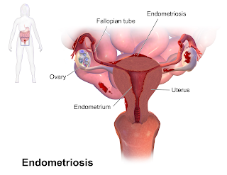 obat endometriosis herbal