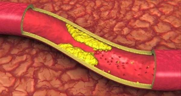 drink-for-Clogged-Arteries-High-Blood-Pressure-And-Bad-Cholesterol