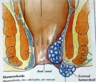 cara mengobati ambeien berdarah
