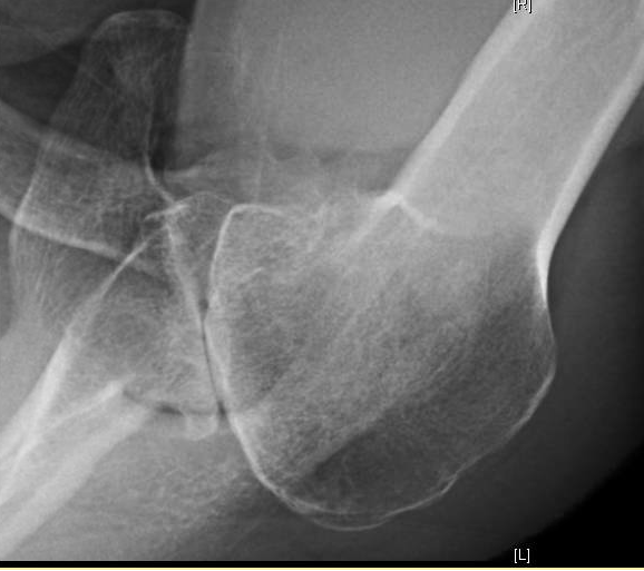 Shoulder Arthritis / Joint Replacement Evaluating the arthritic