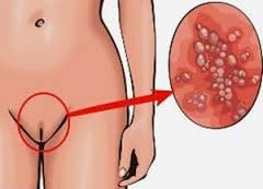 herpes di kemaluan wanita herpes di kemaluan wanita