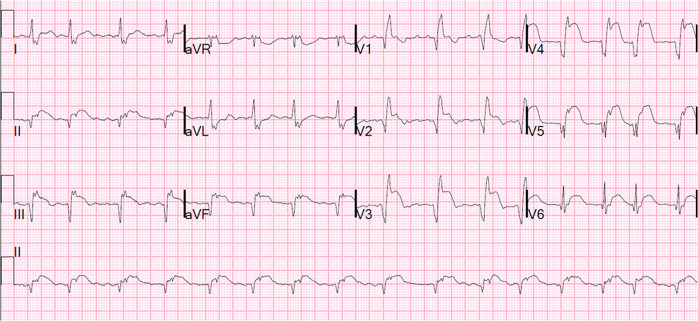 Dr Smiths Ecg Blog Subacute Anteroseptal Stemi With Persistent St