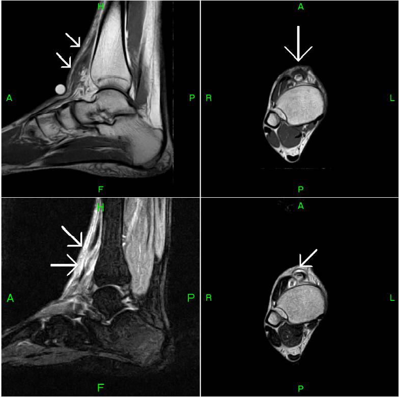 Tibialis Anterior Rupture MRI Sumer S Radiology Blog Hot Sex Picture