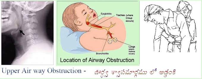 ఊర్ధ్వ శ్వాసమార్గంలో అడ్డంకి,Upper Respiratary Tract Obstruction