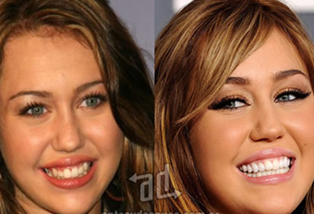 la cirugia de dientes Miley Cyrus
