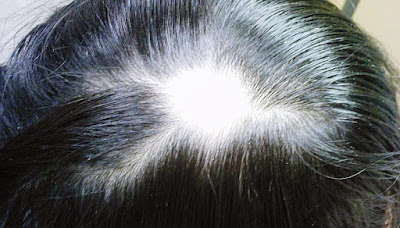 Penumbuh Rambut Secara Alami Penumbuh Rambut Secara Alami
