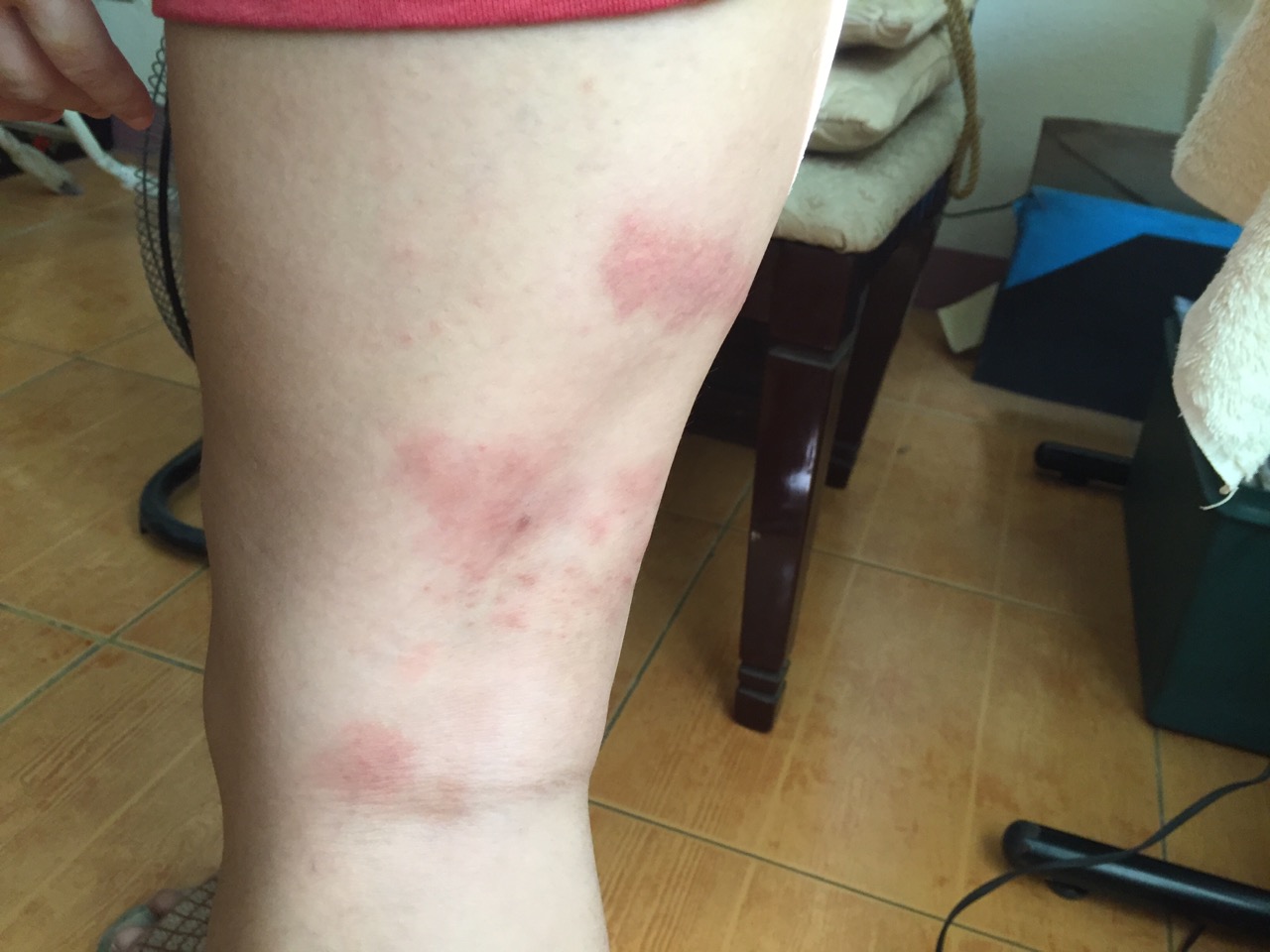 Dropped like a Hatputito: Experience | Bites Turned Into Rashes?