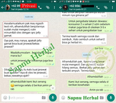 Cara Menghilangkan Benjolan Lemak Di Tubuh Selain Operasi Cara Menghilangkan Benjolan Lemak Di Tubuh Selain Operasi
