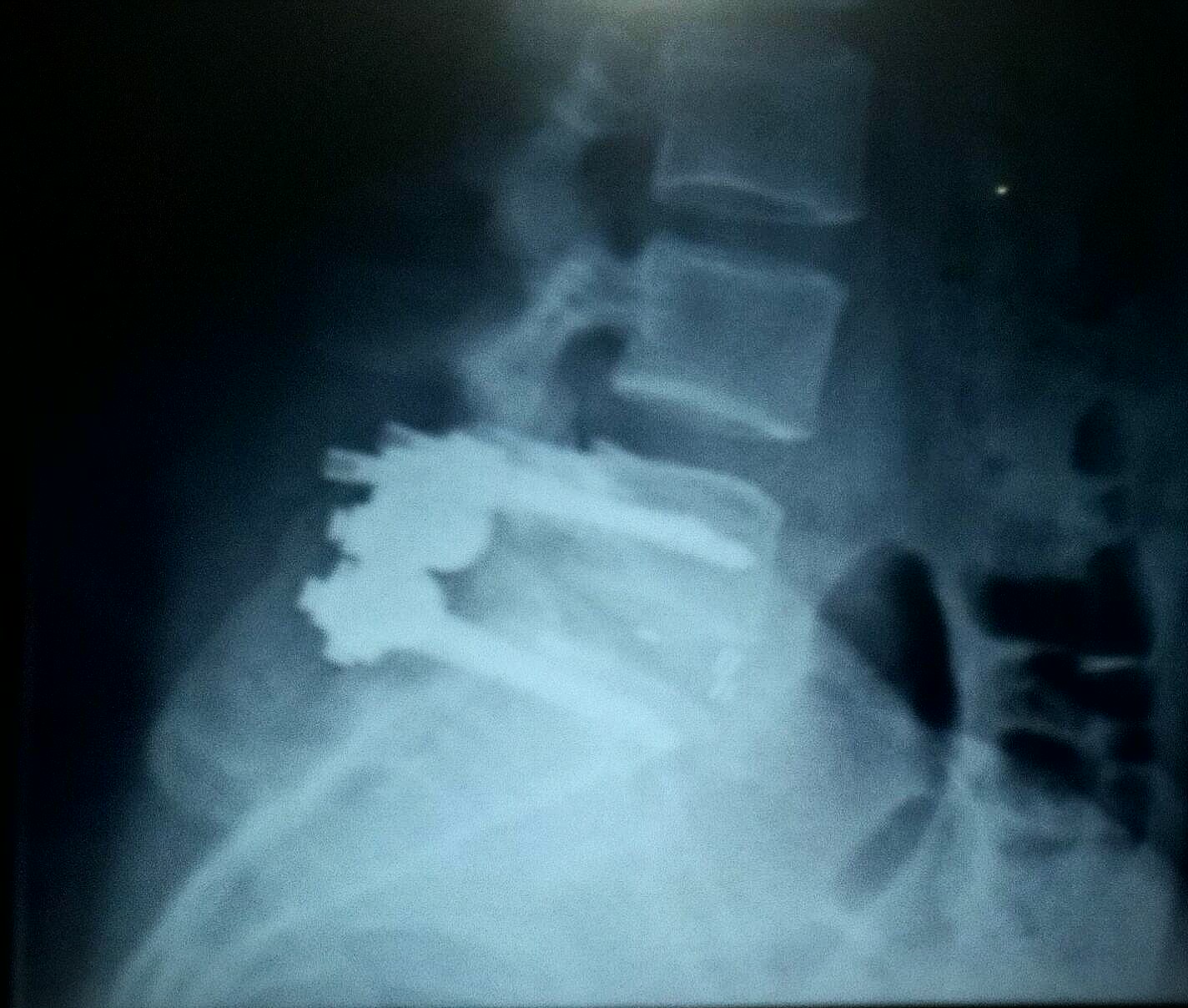 My L5 S1 Spinal Fusion 1st Set Of X Rays Second Post Op Visit W Surgeon And Pictures