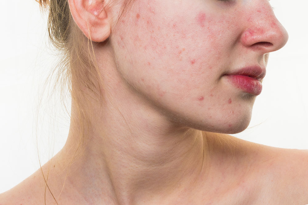 Rosácea 10 Tratamientos Naturales Y Efectivos Remedio Natural Para Curar La Rosacea