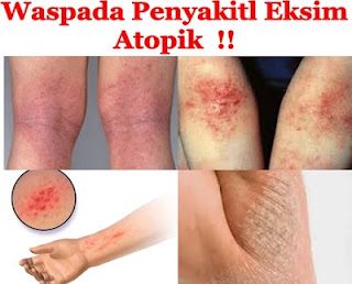 Obat Eksim Obat Eksim