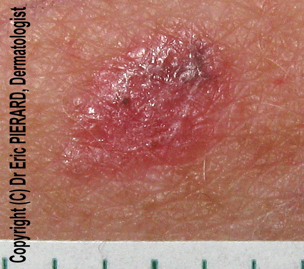 dermoscopy-red-lesion-on-an-arm