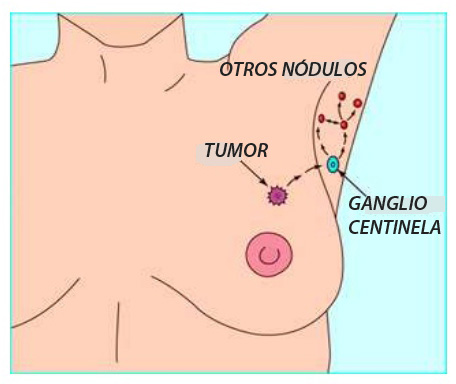 Ingle ganglios en la