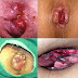PENGOBATAN WASIR TERBARU thumbnail